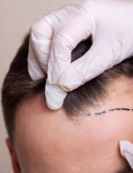 https://phoenixcosmeticcentre.com/public/hair-transplant-surgery